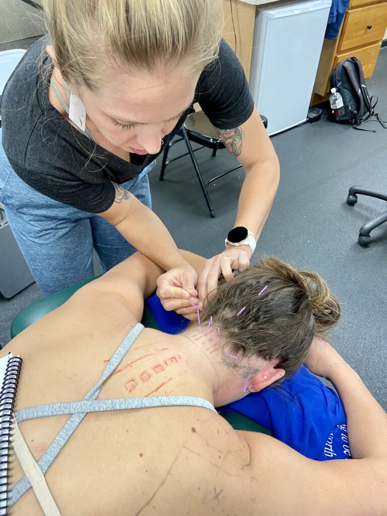 Dry needling. Acupuncture. Chinese . Medicine
